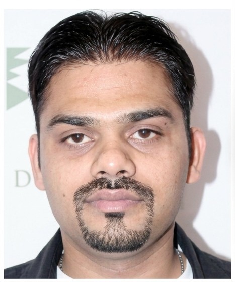 After hair replacement - male client