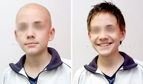 Medical wig before and after