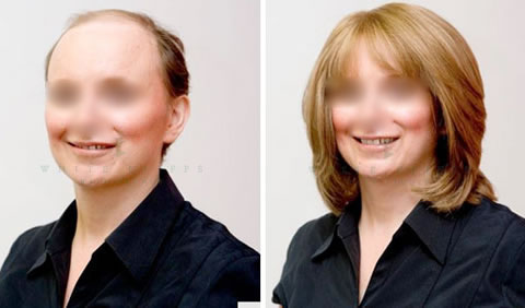 Medical wig before and after