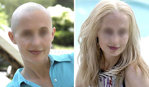 Medical wig before and after
