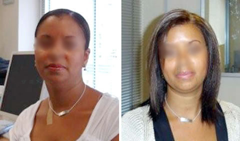 Medical wig before and after