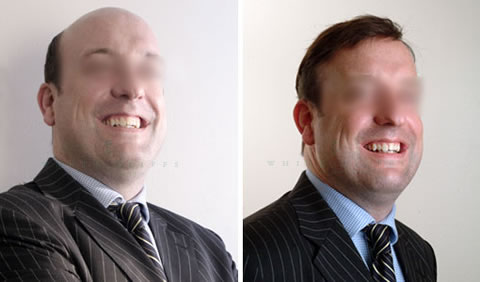 Men's hair replacement before and after - Client 2