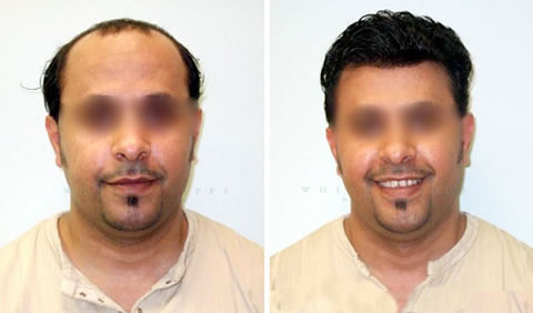 Men's hair replacement before and after - Client 3