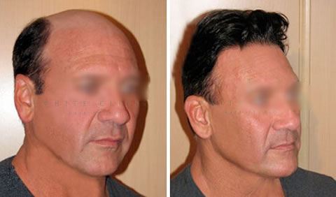 Men's hair replacement before and after - Client 4