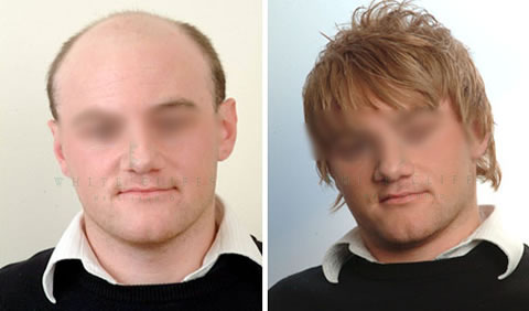 Men's hair replacement before and after - Client 5