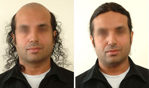 Men's hair replacement before and after - Client 6