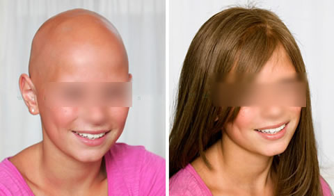 Women's hair replacement before and after