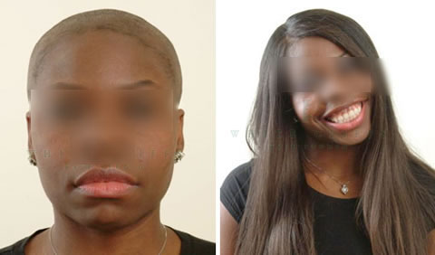 Women's hair replacement before and after