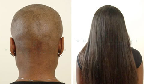 Women's hair replacement before and after