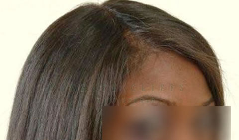 Women's hair replacement before and after